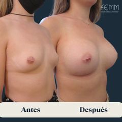 Aumento de pecho con prótesis redondas de 300 cc retropectorales - Clínica FEMM