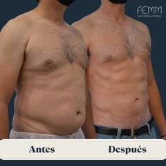 Liposucción abdominal masculina - Clínica FEMM