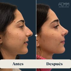 Rinoplastia abierta - Clínica FEMM