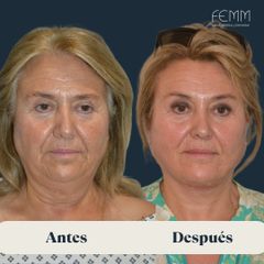 Lifting facial - Clínica FEMM