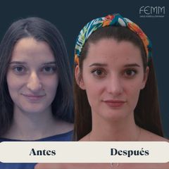 Rinoplastia abierta - Clínica FEMM