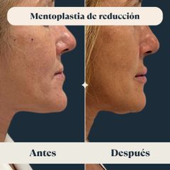 Mentoplastia de reducción - Clínica FEMM