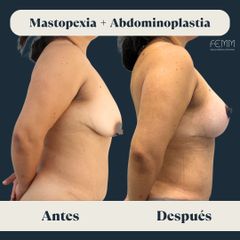 Mastopexia + abdominoplastia secundaria - Clínica FEMM