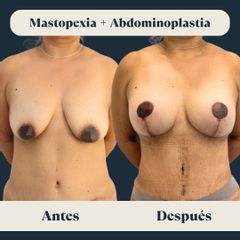 Mastopexia + abdominoplastia secundaria - Clínica FEMM