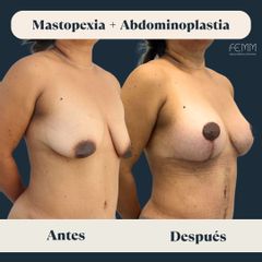 Mastopexia + abdominoplastia secundaria - Clínica FEMM