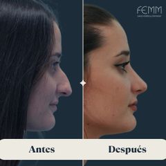 Rinoplastia abierta - Clínica FEMM