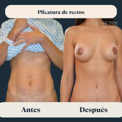 Mommy Makeover - Clínica FEMM