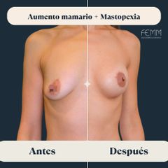 Mommy Makeover - Clínica FEMM