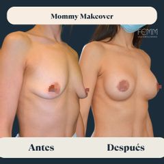 Mommy Makeover - Clínica FEMM