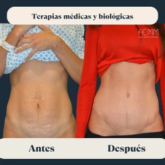 Mommy Makeover  - Clínica FEMM