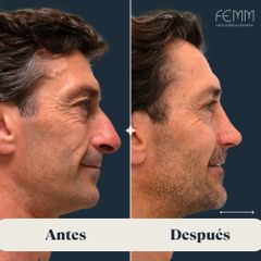 Rinoplastia masculina - Clínica FEMM