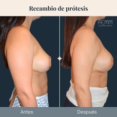 Recambio de prótesis - Clínica FEMM