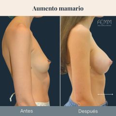 Aumento mamario - Clínica FEMM