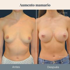 Aumento mamario - Clínica FEMM