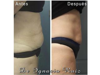 Antes y después Tratamiento con Prostrolane para adiposidades grasas en abdomen