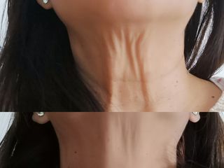 Antes y después Tratamiento de cuello 