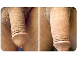 Engrosamiento de pene - Doctor Peinado