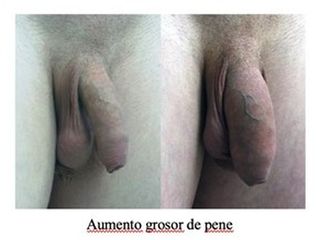 Engrosamiento de pene - Doctor Peinado