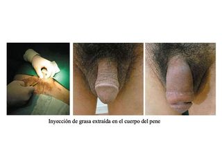 Engrosamiento de pene - Doctor Peinado