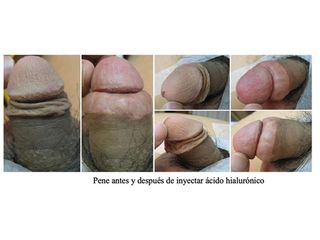 Engrosamiento de pene - Doctor Peinado