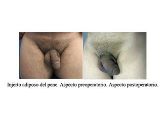 Engrosamiento de pene - Doctor Peinado