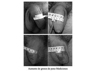 Engrosamiento de pene - Doctor Peinado