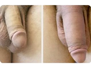 Alargamiento de pene - Doctor Peinado
