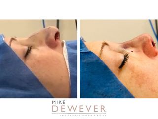 Antes y después Rinoplastia - Clinica Belba