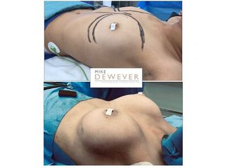Antes y después Aumento mamario prótesis ergonómicas - Clinica Belba
