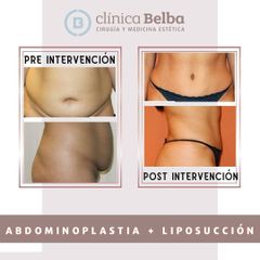 Abdominoplastia - Clinica Belba