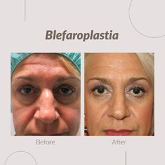 Blefaroplastia - Clinica Belba