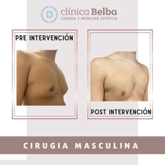 Ginecomastia - Clinica Belba