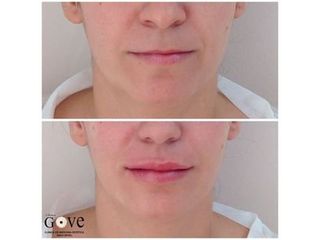 Aumento de labios -  Clínica Gove