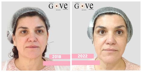 Rejuvenecimiento facial - Clínica Gove