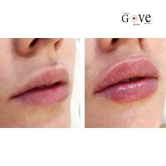 Aumento de labios - Clínica Gove
