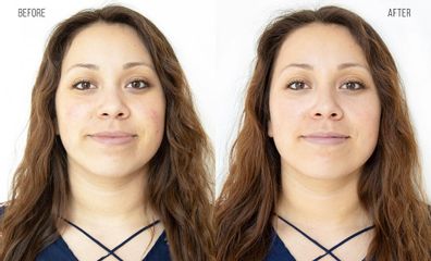Rejuvenecimiento facial - Clínica Gove