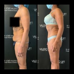 Liposucción - Dr. José Valero