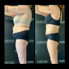 Liposucción - Dr. José Valero