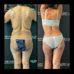 Liposucción - Dr. José Valero