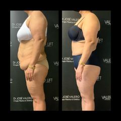 Liposucción - Dr. José Valero