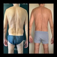 Liposucción - Dr. José Valero