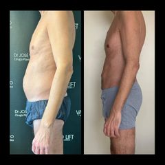 Liposucción - Dr. José Valero