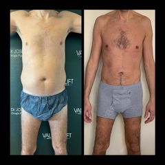 Liposucción - Dr. José Valero