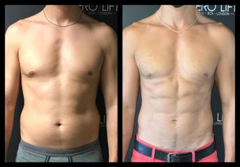 Marcación Abdominal - Dr. José Valero