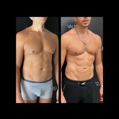 Marcación Abdominal - Dr. José Valero
