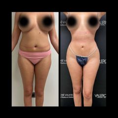 Liposucción - Dr. José Valero