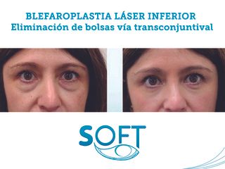 Antes y después Blefaroplastia transconjuntival