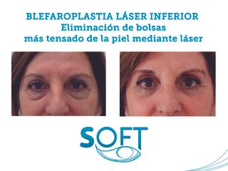 Antes y después Blefaroplastia láser inferior
