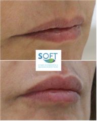 Aumento de labios - Clínica Soft