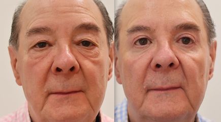 Blefaroplastia completa en hombres